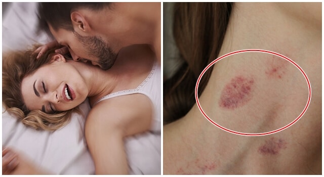 Hickey kiss là gì? Cách tạo hickey và xóa hickey như nào?