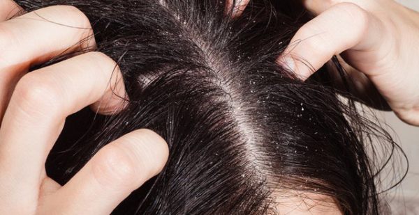 Shampoo là gì? Cách phân loại Shampoo và những lưu ý khi sử dụng