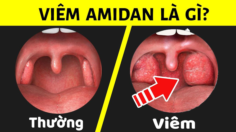 Amidan là gì? Làm cách nào để giữ cho Amidan luôn khỏe?