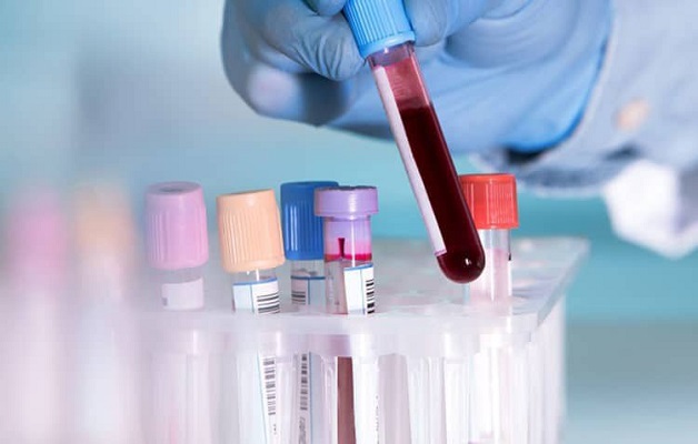 LYM trong xét nghiệm máu là gì? Cách đọc chỉ số LYM | TCI Hospital